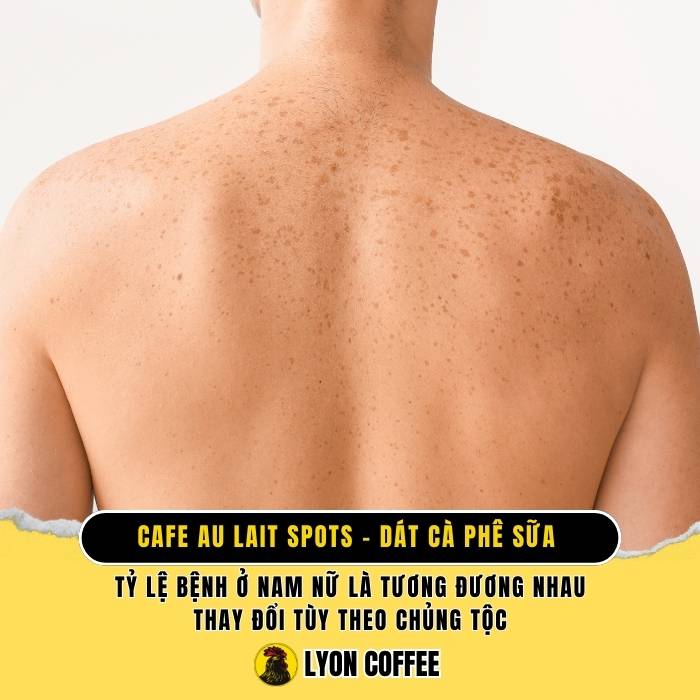 Bớt dát cà phê sữa Cafe Au Lait Spots là gì, nổi 3 4 bớt biểu hiện bên ngoài, các hội chứng di truyền, diễn tiến và cách điều trị bệnh